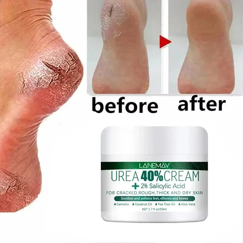 Herbal Remedy For Cracked Heels | Best Ayurvedic Foot Cream For Cracks
