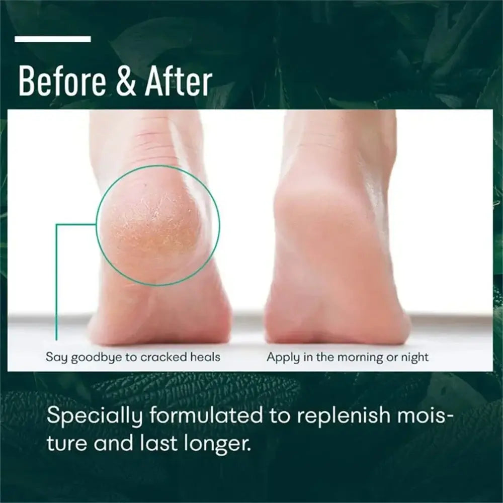 Herbal Remedy For Cracked Heels | Best Ayurvedic Foot Cream For Cracks
