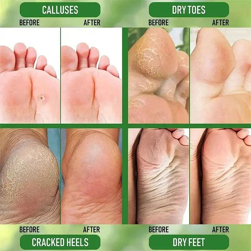 Herbal Remedy For Cracked Heels | Best Ayurvedic Foot Cream For Cracks
